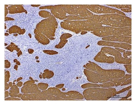 Immunolocalization Of Ae1ae3 In Lymph Node Metastasis Of Nasal