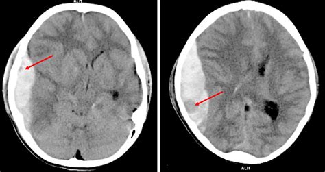 Swirl Sign Intracranial Hemorrhage Radiology Cases