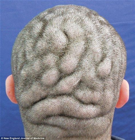 Man Suffers Bizarre And Rare Medical Condition That Makes His Scalp