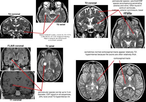 Normal Anatomy Of The Brain On Ct And Mri With A Few Normal Variants