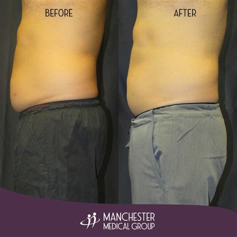Steve Sculpsure Before After 2 Manchester Medical Group