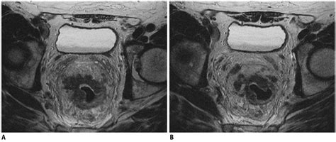 Accuracy Of High Resolution Mri With Lumen Distention In Rectal Cancer Staging And
