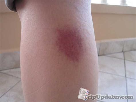 Symptoms may develop hours after a mosquito bite. Pin on Skeeter Syndrome Pictures