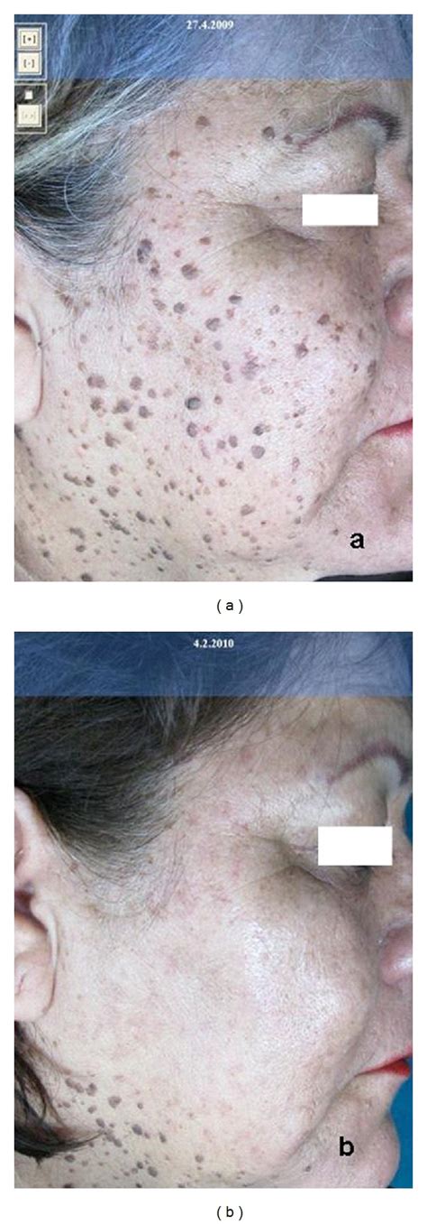 Dermatosis Papulosa Nigra At First A And After One B Treatment With