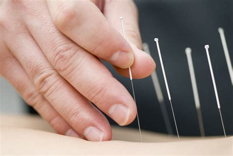 Akupunktur Praxis Für Chinesische Medizin Und Akupunktur In Zofingen