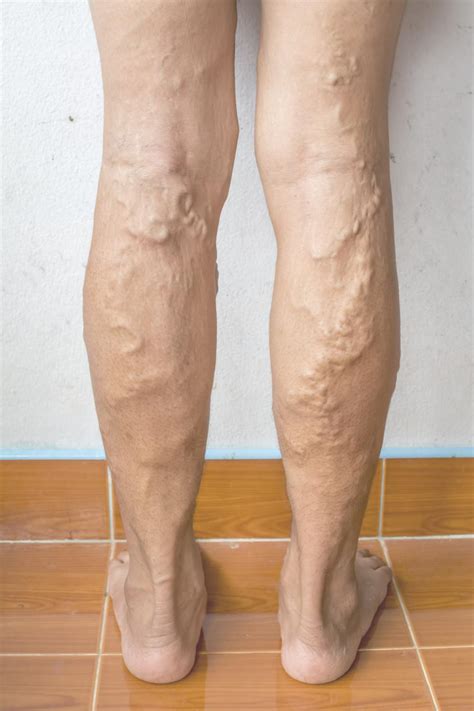 Mythbusting Mondays Varicose Veins Are Just A Cosmetic Issue Center