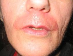 They say that the skin rash is a hypersensitivity reaction that is most likely to affect people who already suffer from allergies such as hayfever or asthma. Dont Use NAIR Hair Remover! - Nair