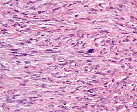 Histological Section Shows A Typical Malignant Fibrous Histiocytoma