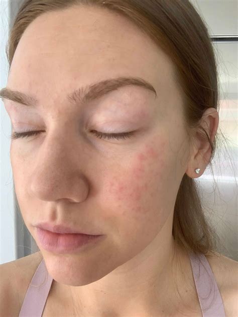 Allergic — this word means unusually sensitive to a condition or substance (an allergic reaction to nylon) dictionary of problem words and expressions. SOS! Please help a mama out! Allergic re... - Beauty ...