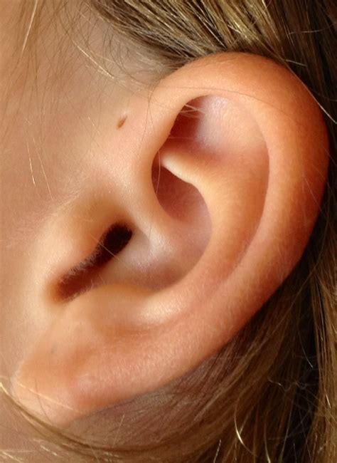 What Are Pre Auricular Cysts Isaac Namdar Md