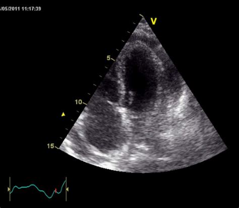 The Apical Four Chamber View Of The Transthoracic Echocardiogram Download Scientific Diagram
