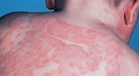 Eczema AtÓpico Binipatia E Higienismo
