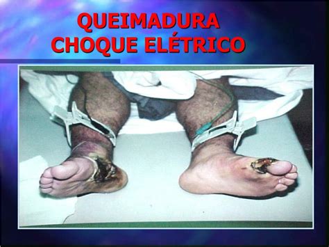 Queimadura De Choque Eletrico