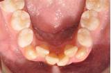 Images of Lower Teeth Crowding Treatment