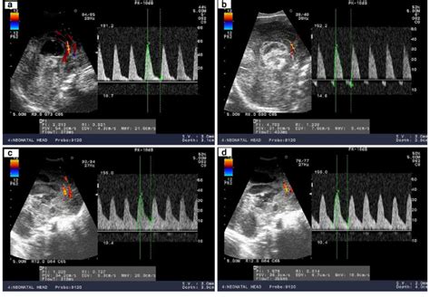 Doppler Parameters Of Aca Of Premature Newborn With Hydrocephalus