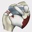 Treating The Most Common Skiing Injury A Torn Rotator Cuff