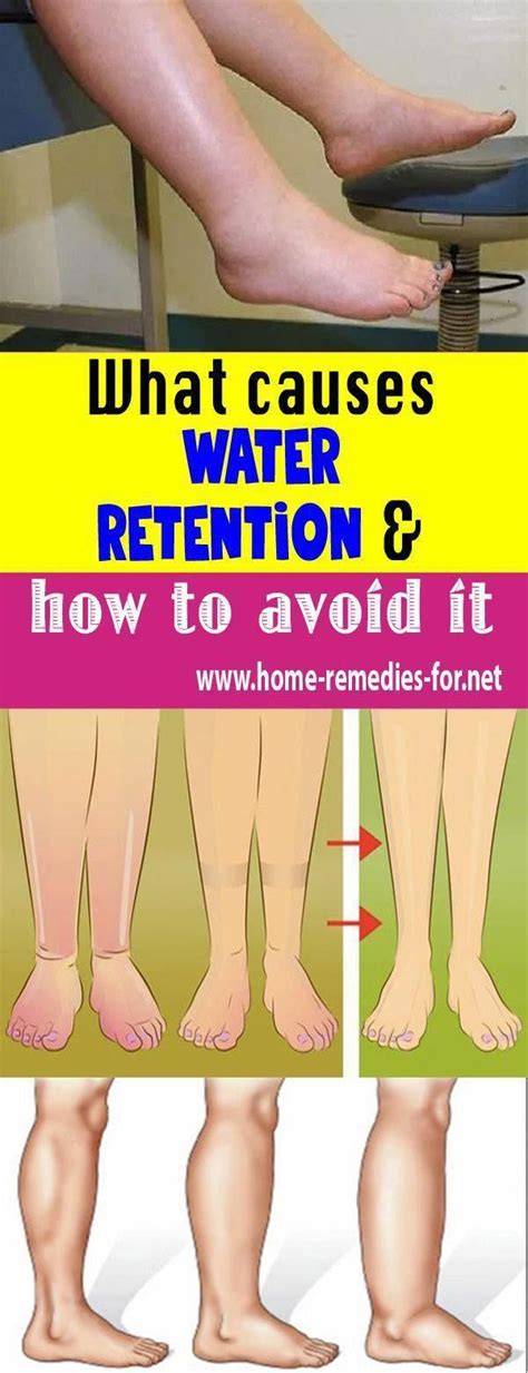 What Causes Water Retention And How To Avoid It Home Remedies