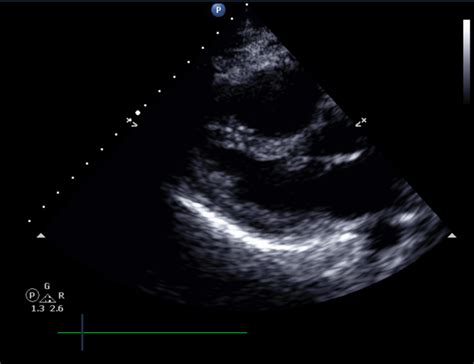 Cureus Acute Right Ventricular Dysfunction Secondary To Hereditary