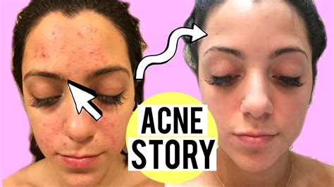 My Acne Story Clogged Pores To Clear Skin How I Cleared My Skin