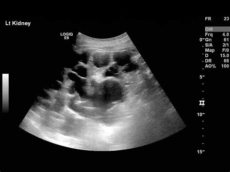 Since its introduction in 1951, percutaneous renal biopsy has become an integral part of the clinical practice in nephrology and subsequently revolutionized the. Autosomal Dominant Polycystic Kidney Disease (ADPKD ...