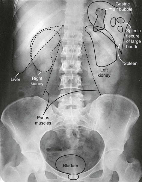 Introduction To Abdomen Radiography Radiology Key