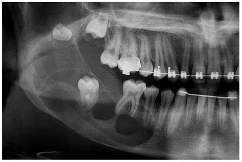 Eruption Cyst Radiography