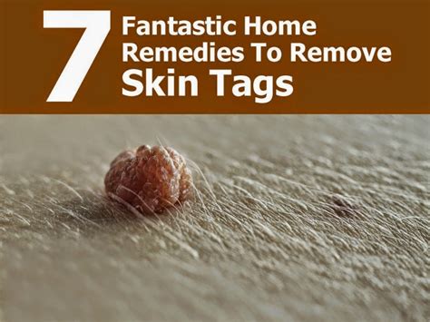 7 fantastic home remedies to remove skin tags handy diy