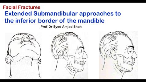 Extended Submandibular Approaches To The Inferior Border Of The Mandible English Syed Amjad