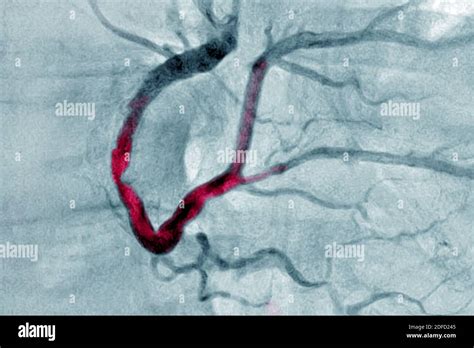 Infarto De Miocardio Con Trombo Significativo En La Coronaria Derecha