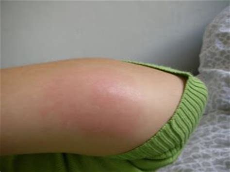 In most cases, individuals with history of allergic reactions are the ones who suffer from this disease. 77 best Skeeter Syndrome Pictures images on Pinterest ...