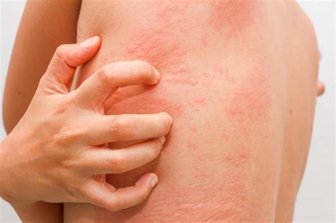 What Is Chronic Urticaria