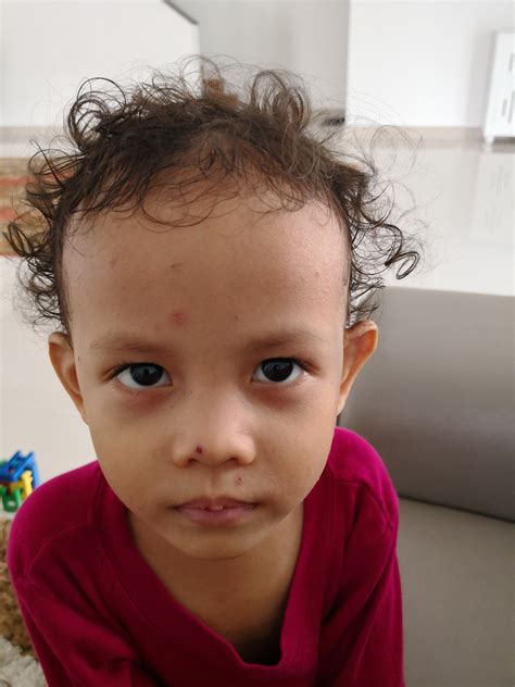 These blisters burst and form crust (scab) which leaves the these natural remedies are safe and inexpensive, and they help to significantly fade the appearance of chicken pox scars. Chicken Pox Campak Sekam Tips Penjagaan, Cara Hilangkan ...