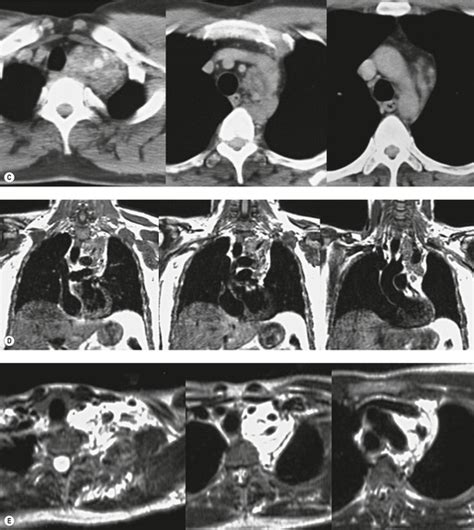 14 Mediastinal And Aortic Disease Radiology Key