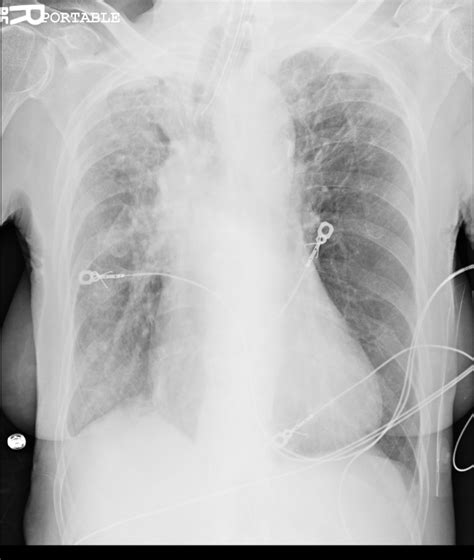 X Ray Vision Stories In The Chest X Ray County Em