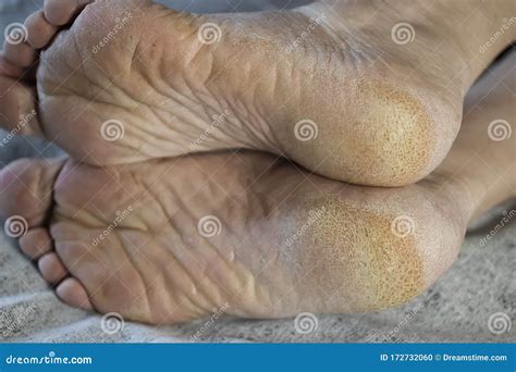 Feet Of A Patient With Diabetes Diabetic Foot Hyperkeratosis And