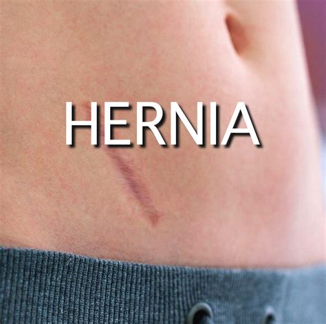 Hernia Prophylactic Mesh Placement To Avoid Incisional Hernias After