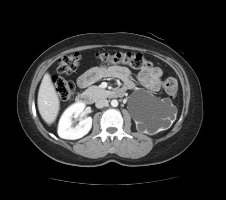A radiology nurse or a radiology technologist may administer intravenous contrast media under the general supervision of a. Severe hydronephrosis: cause unknown | Image | Radiopaedia.org