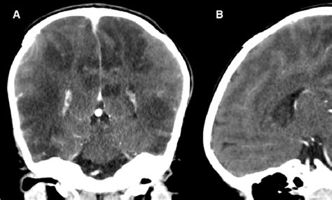 Figure 6 From Imaging Spectrum Of Hypoxic Ischemic Brain Injury In