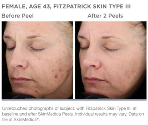 If you book in for the treatment, the aesthetician will apply anesthetic to your skin before inserting the threads with a you may feel a tightening under the skin and experience bruising, swelling and pain the area the thread was inserted in the weeks after. SkinMedica's Vitalize Peel | Chemical Peel Los Angeles ...