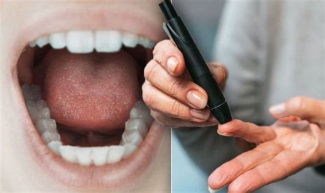 Diabetes Type 2 Warning The Feeling In Your Mouth That You Should