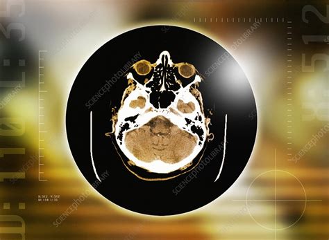 Healthy Brain Ct Scan Stock Image P3320418 Science Photo Library