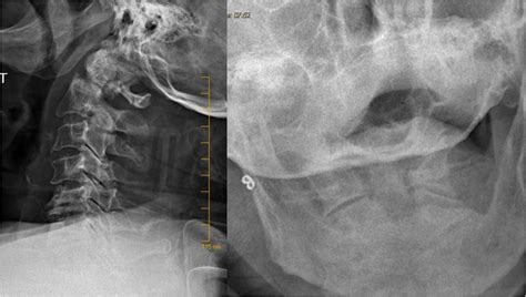 X Rays Of The Cervical Spine Lateral And Open Mouth Views Showing