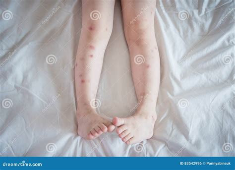 Mosquito Bites Sore And Scar On Child Legs Stock Photo Image Of