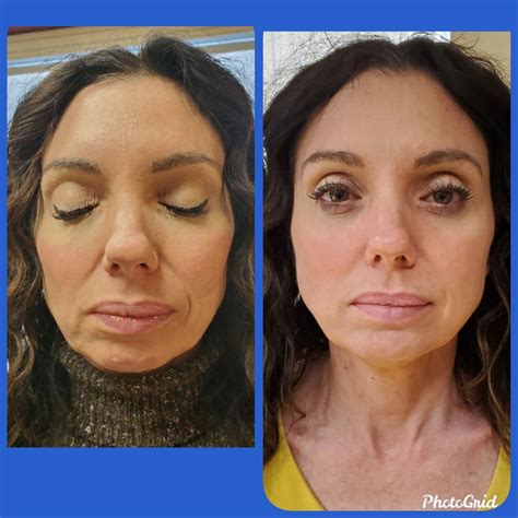 Get Rid Of Jowls Easily With Filler