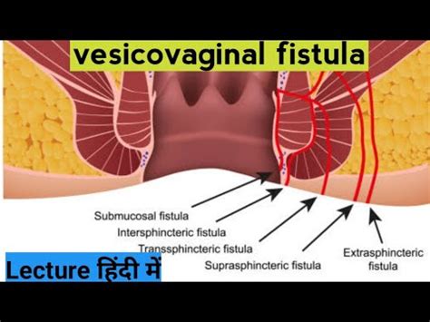 Vaginal Approch To Vesicouterine Fistula Youtube My Xxx Hot Girl