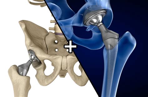 Hip Replacement 3d Model