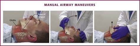 Basic Airway Management And Decision Making Clinical Gate