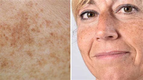 What Are Age Spots And How Do I Get Rid Of Them Health In Progress