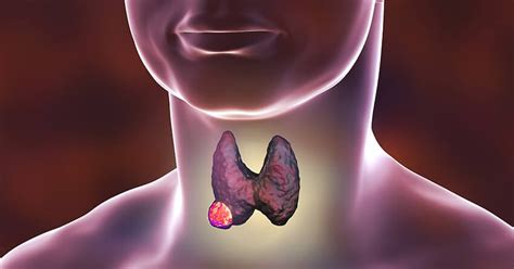 If You Have A Lump In Your Neck It Could Be Thyroid Cancer
