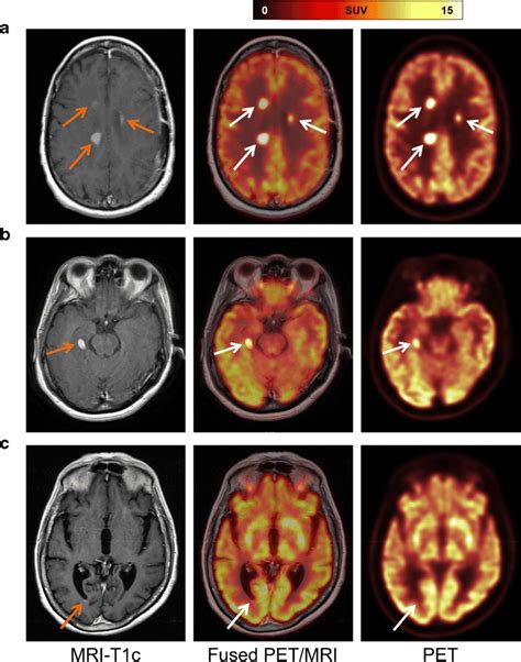 Representative Cases A Patient Diagnosed With Secondary Cns Lymphoma